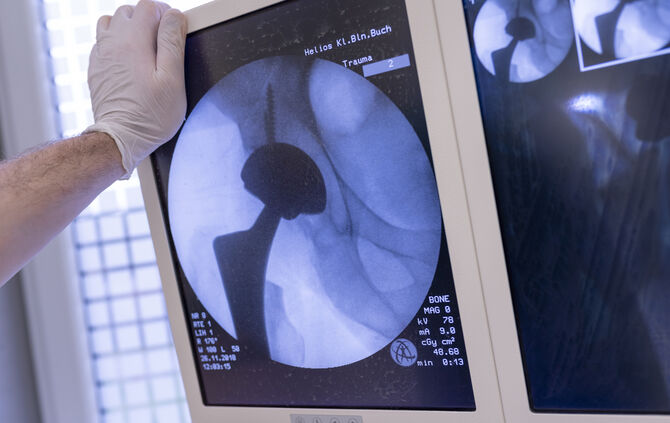 Kaputte Knie oder Hüften: Wann ein neues Gelenk her muss