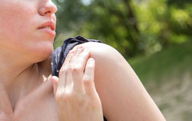 Mückenstiche sollte man niemals aufkratzen.