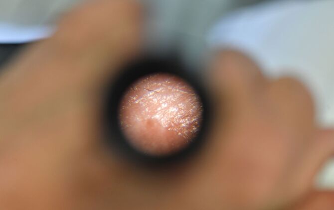 Ein Altersfleck durch eine Lupe an einer Hand