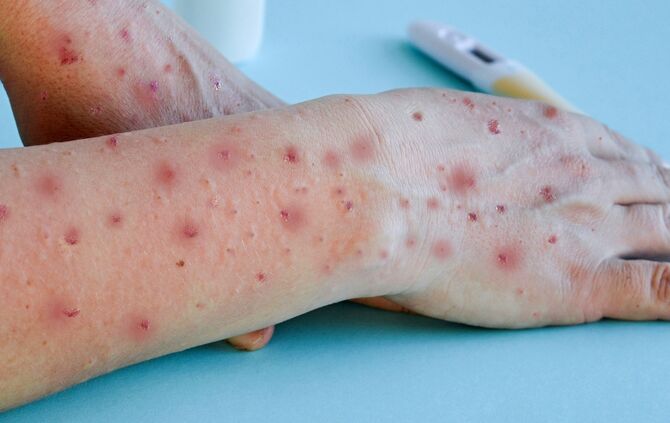Monkey pox virus, a new world problem of modern humanity. Close-up of the hands of a sick person with pimples and blisters.