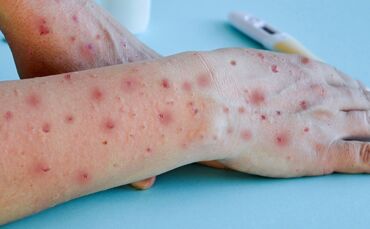 Monkey pox virus, a new world problem of modern humanity. Close-up of the hands of a sick person with pimples and blisters.