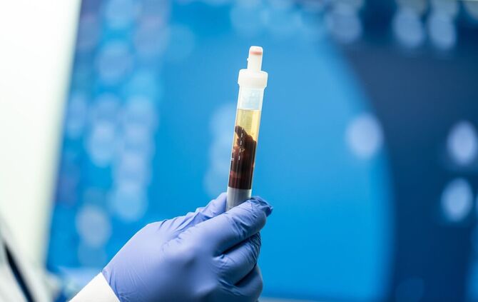 Blutprobe - Symbolbild