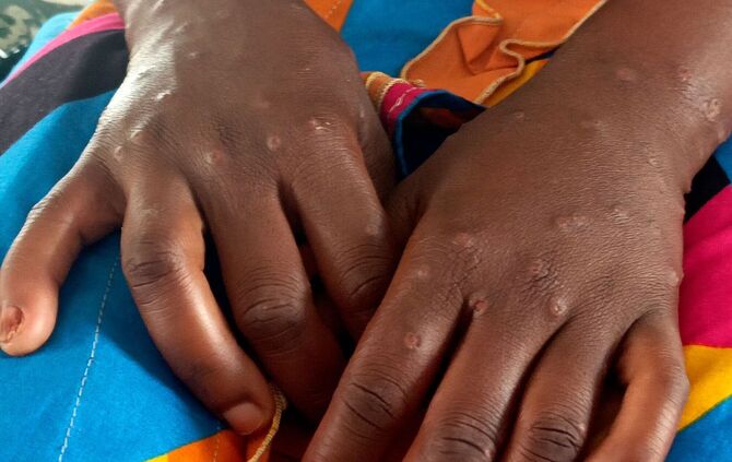 Mpox
