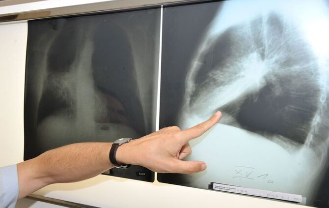 Ab April soll es losgehen mit dem neuen Programm zur Früherkennung von Lungenkrebs.