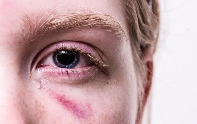 Verletzung am Auge (Symbolfoto).