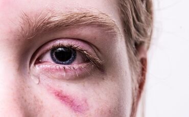 Verletzung am Auge (Symbolfoto).