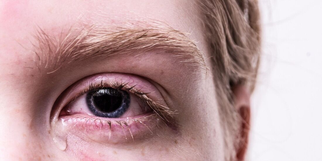 Verletzung am Auge (Symbolfoto).