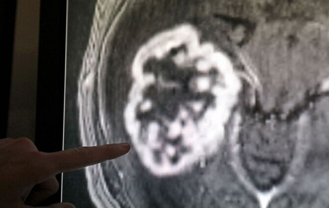 Die Diagnose Krebs ist oft ein schwerer Schlag