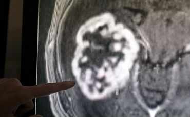 Die Diagnose Krebs ist oft ein schwerer Schlag 