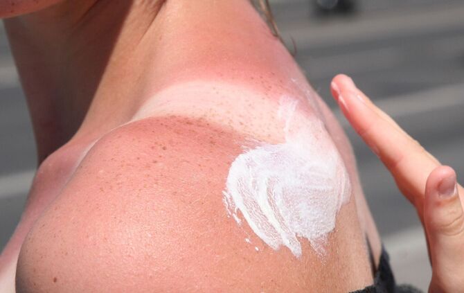 Eine Frau trägt Creme auf einen Sonnenbrand auf